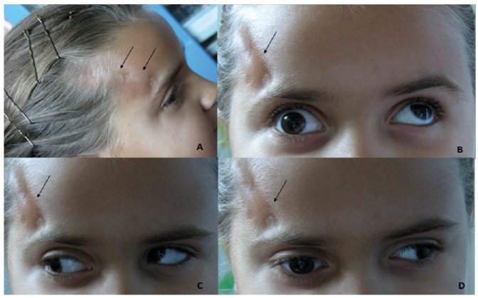 Acquired Strabismus in Linear Scleroderma of the Face | HTML | Acta