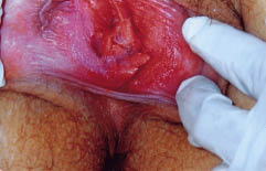 vestibularis papillomatosis krém