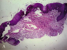 Amely a vestibularis papillomatosis