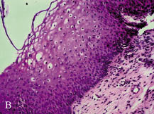 Vestibular papillomatosis histopathology. Vestibular papillomatosis or herpes