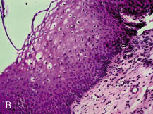 vestibularis papillomatosis fogamzásgátlás