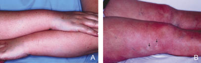 Persistent Painful Indurated Erythema Secondary to Bosentan | HTML ...