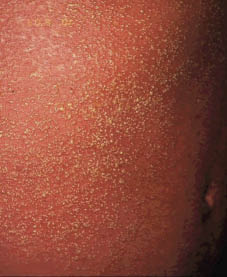 agep rash