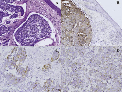 acta cutaneous keratoacanthoma metastasis lung cancer learning point