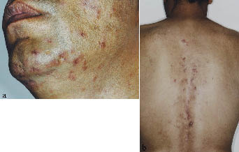 A Case Of Discoid Lupus Erythematosus Masquerading As Acne Html