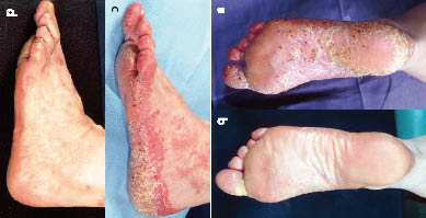 palmar plantar psoriasis