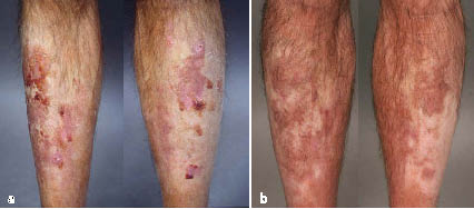 Overuse of topical corticosteroids