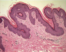 confluent and reticulated papillomatosis histopathology vierme rotunde de unde apare