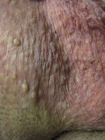 wart on scrotum skin