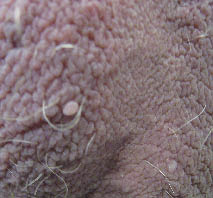 papilom testicular