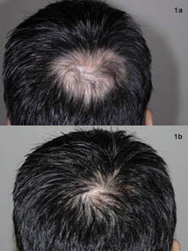 Successful Hair Re-growth with Multimodal Treatment of Early Cicatricial  Alopecia in Discoid Lupus Erythematosus | HTML | Acta Dermato-Venereologica