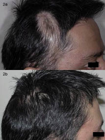 Successful Hair Re-growth with Multimodal Treatment of Early Cicatricial  Alopecia in Discoid Lupus Erythematosus | HTML | Acta Dermato-Venereologica