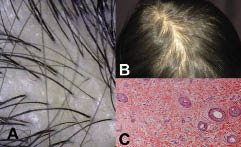 Female Pattern Hair Loss in a Patient with 17α-hydroxylase Deficiency |  HTML | Acta Dermato-Venereologica