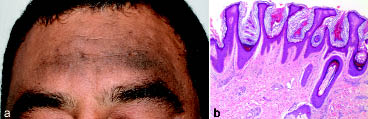 hyperkeratosis papillomatosis és acanthosis)