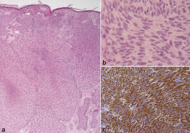 Central Nuclear Palisading In Nodular Basal Cell Carcinoma