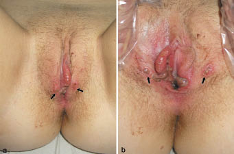 16 yaşında kadın, genital herpes , EBV