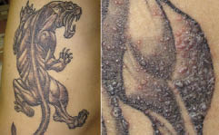 Mycobacterium chelonae Infection Associated with Tattoos | HTML | Acta  Dermato-Venereologica