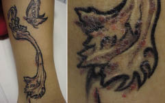 Mycobacterium chelonae Infection Associated with Tattoos | HTML | Acta Dermato-Venereologica Mycobacterium chelonae Infection Associated with Tattoos | HTML | Acta Dermato-Venereologica