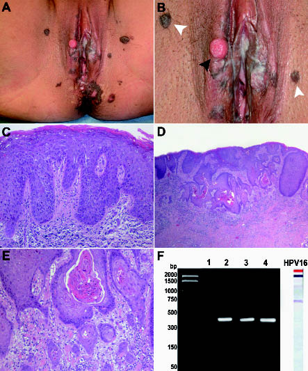 bowenoid papilloma gége papilloma etiológiája