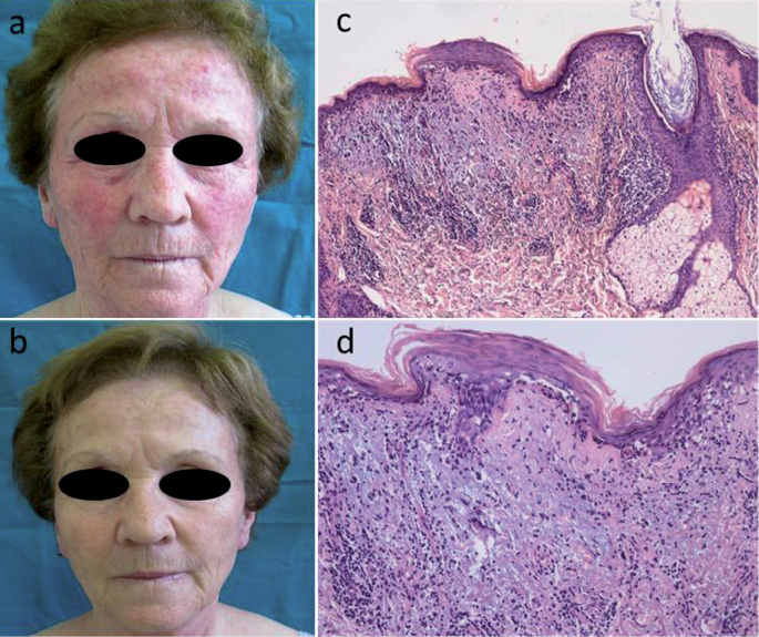 Acne Rosacea Vs Lupus Rash Lupus Misdiagnosis Diseases That Can Mimic