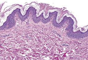 Confluent and reticulated papillomatosis pathology, Reticulated papillomatosis histology