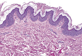 Papillomas and hyperkeratosis. Hpv symptoms warts on hands