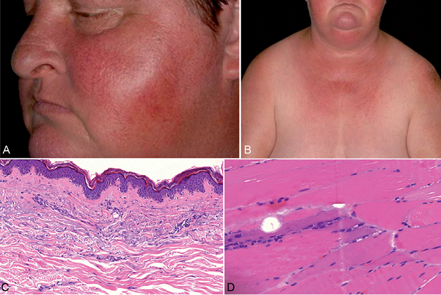 Acta Dermato-Venereologica - Antisynthetase Syndrome: A 