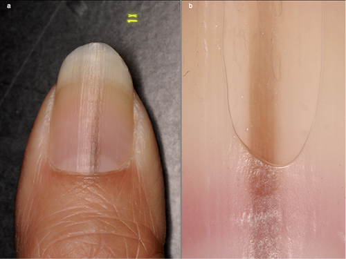 Dermoscopic features of nail matrix nevus (NMN) in adults and children: A  comparative analysis - ScienceDirect