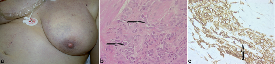 What is lymphoma of the skin?