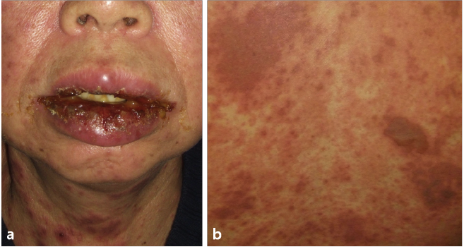 Clinical presentations of DRESS/DIHS. (A) The skin rash of DRESS