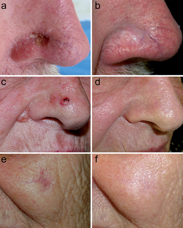 Immunocryosurgery For Non Superficial Basal Cell Carcinoma A