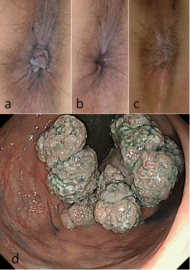 Aftermath Of Anal Sex