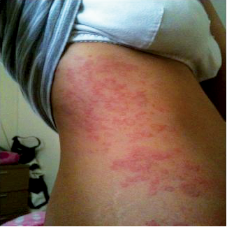 orticaria vasculitica)