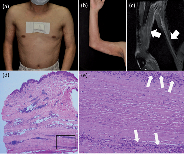 Eosinophilic Fasciitis Following Allogeneic Bone Marrow Transplantation