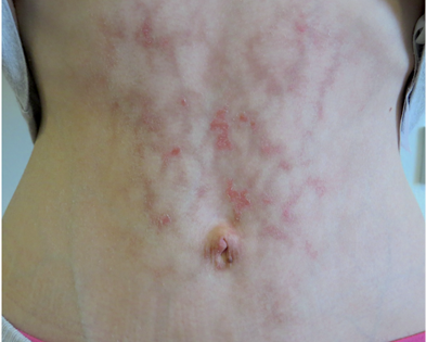 A Reddish Brown Reticulated Hyperpigmented Erythema on the Abdomen of a  Girl: A Quiz, HTML