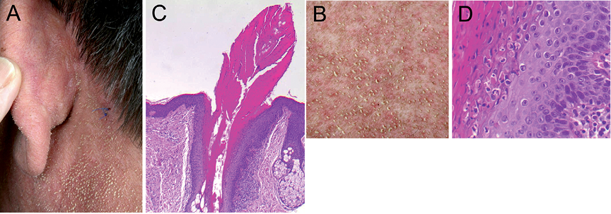 follicular hyperkeratosis face