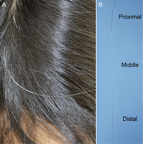 Segmented Heterochromia in a Single Scalp Hair | HTML | Acta  Dermato-Venereologica