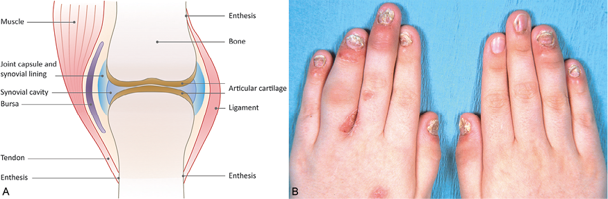 plaque psoriasis vs psoriatic arthritis