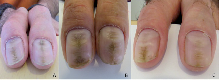 An Atlas of Nail Disorders, Part 3 | Consultant360