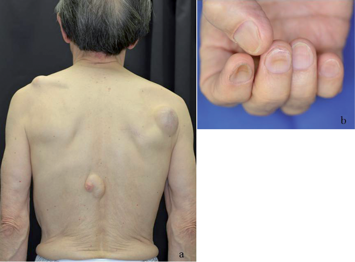 A Syndrome Of Leukonychia Koilonychia And Multiple Pilar Cysts Html Acta Dermato Venereologica