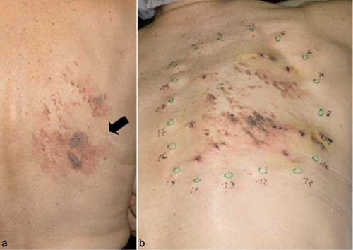 Zosteriform Metastases Of Eccrine Porocarcinoma Mimicking Eruptive