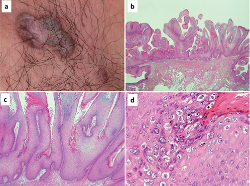 condyloma hyperkeratosis