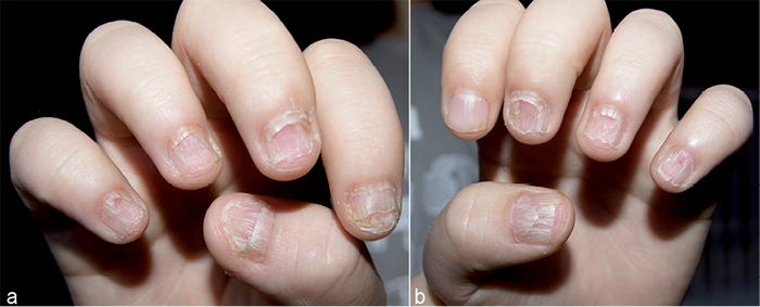 A pilot study of intralesional methotrexate injections versus triamcinolone  acetonide in patients affected by nail matrix psoriasis - Starace - 2022 -  Clinical and Experimental Dermatology - Wiley Online Library