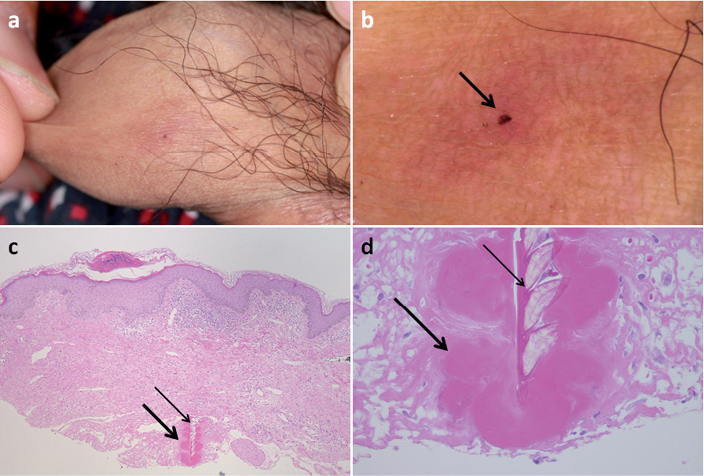 Tick Attachment Cement With A Feeding Cavity In The Deep Dermis Of
