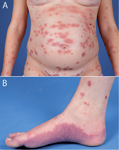 68-Year-Old Male with Intense Itching Followed by Blisters on the Breast