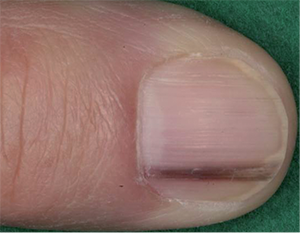 human papillomavirus infection on finger