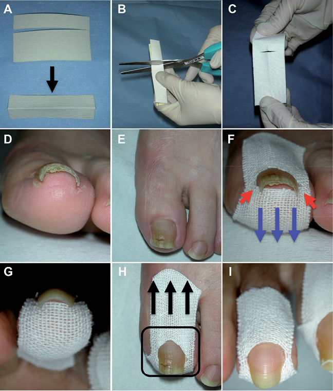 How to Fix Pincer Toenails: Symptoms, Causes, and Treatment | ND Nails  Supply