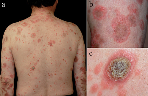 Oral t cell lymphoma