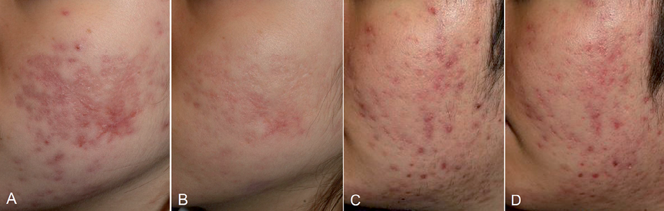 Kết quả hình ảnh cho post inflammatory erythema