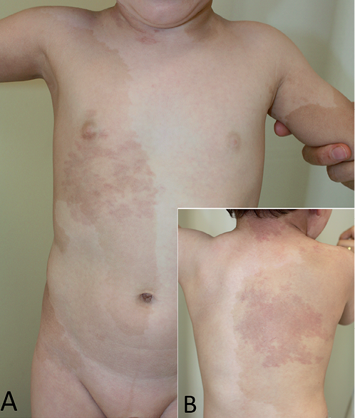 Phacomatosis Melanorosea A Further Case Of An Unusual Skin